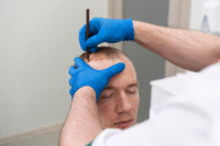 What Patients Should Know Before Hair Transplant Procedures