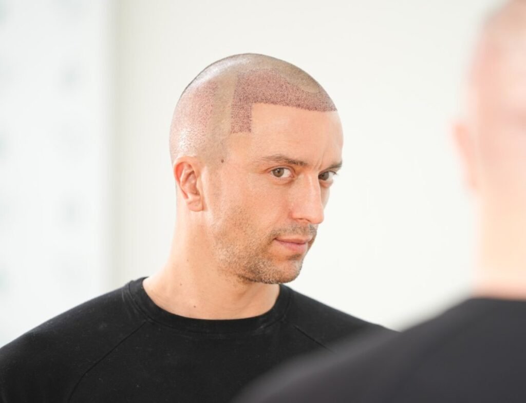 Hair Transplant Turkey Cost